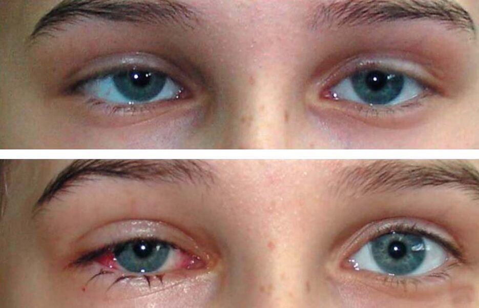 Antes y después del tratamiento Oculax